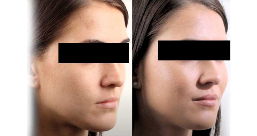 cheek augmentation- before after case by Dr Bhargava