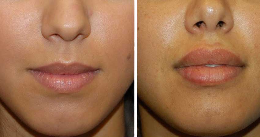 lip surgery-before after case