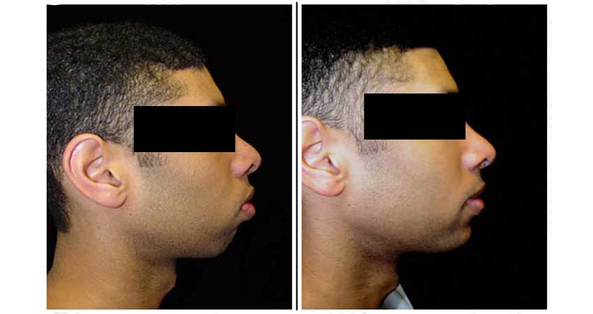 outward chin correction surgery by Dr Bhargava