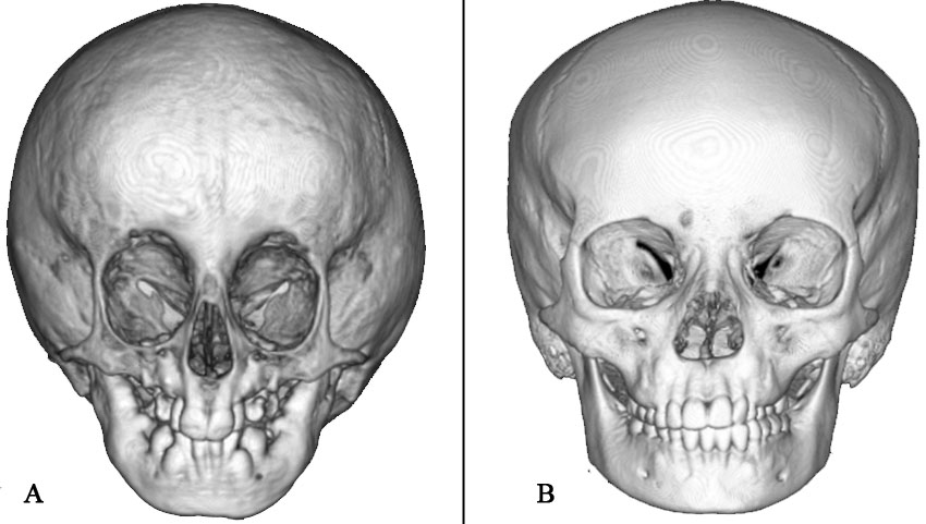 Craniofacial Syndrome that requires Craniofacial surgery