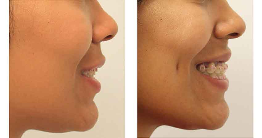 Dimple creation- before after of a case by Dr Bhargava