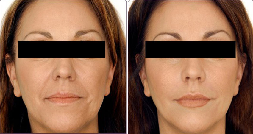 Facelift of botox surgery- real case by Dr Anurag Bhargava