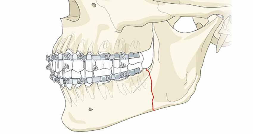 Jaw fractures case