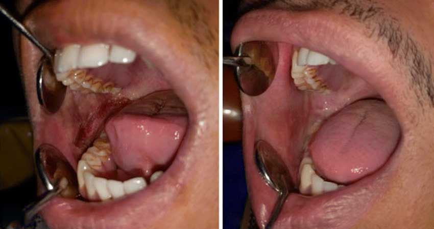 Human mouth- case of OSMF