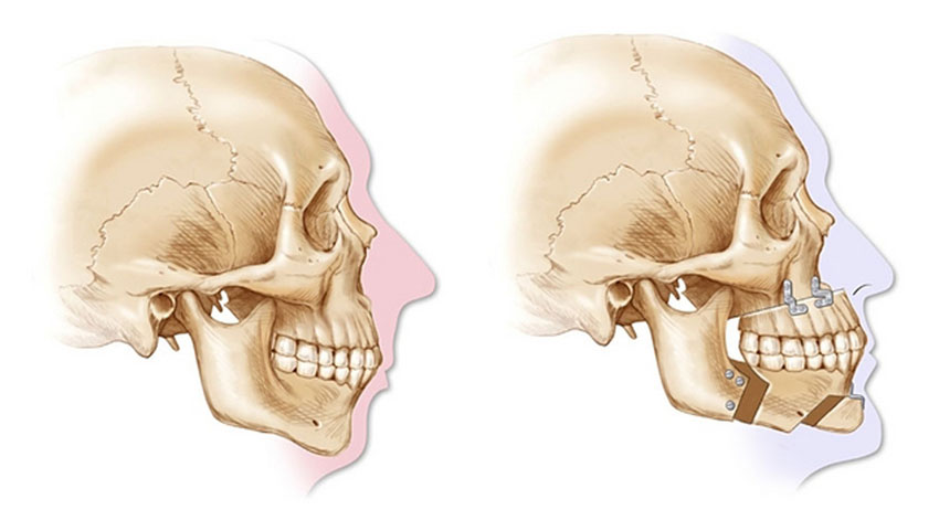 Diagrammatic representation of before and after Orthognathic surgery.