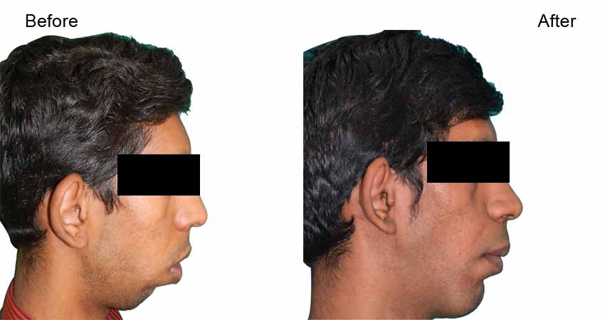 Jaw surgery or jaw correction surgery- before after