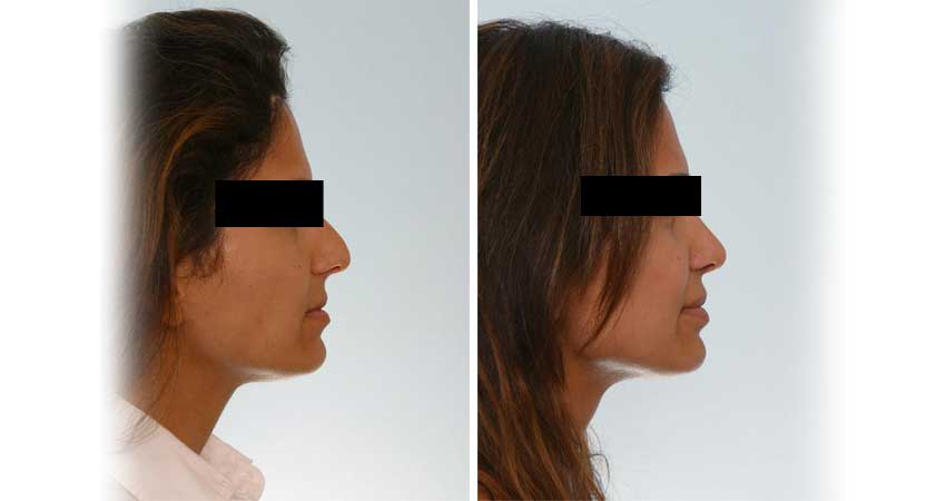 Nose surgery/ nose job- real case before after by Dr Bhargava