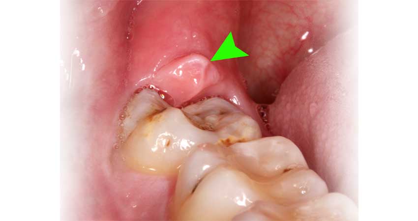example of real case of wisdom tooth