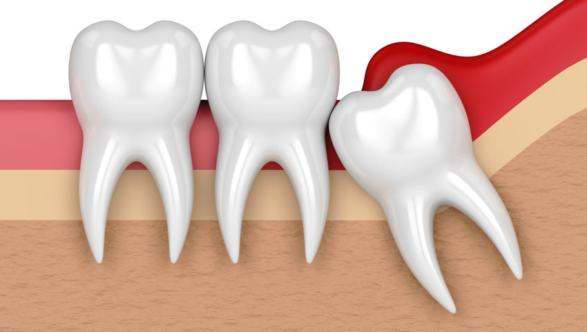 Painless wisdom teeth extraction at affordable prices.