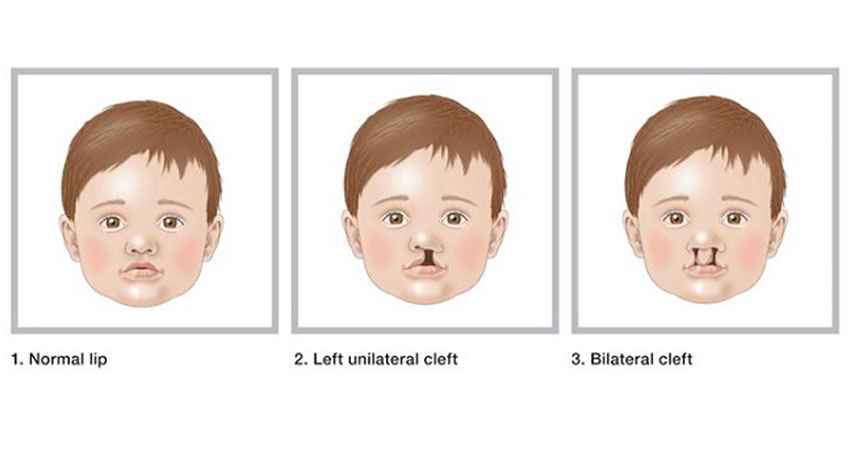 cleft lip categories- left unilateral and bilateral cleft