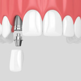 close up of dental implant- abudment and crown