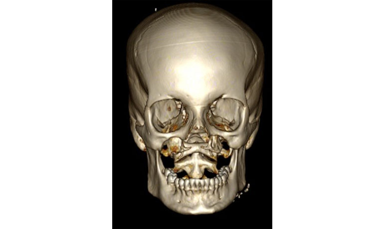 fibula 6 planning