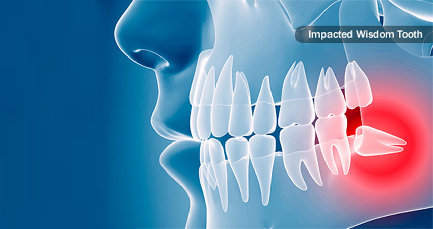 impacted wisdom tooth- wisdom teeth removal