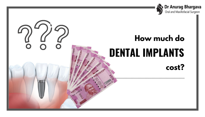 Cost of Dental Implants in India and Factors Affecting It