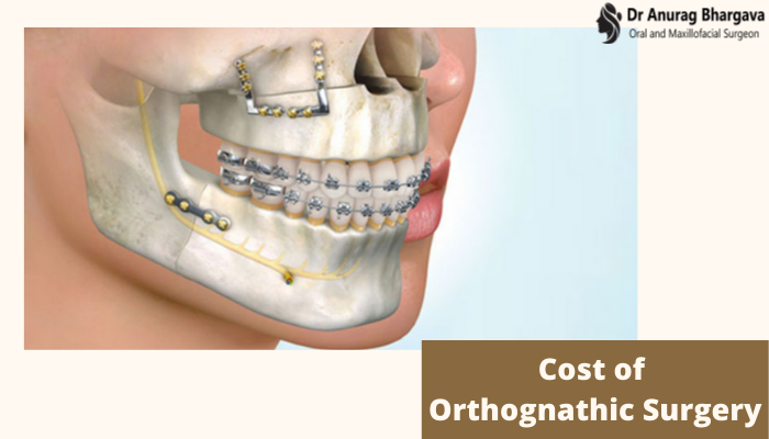 Cost of Orthognathic Surgery in India - The Exact Details by Jaw Surgeon