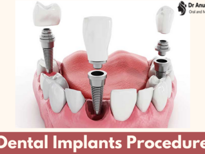 Dental Implants Procedure - Get Answer To Every Query Related To It