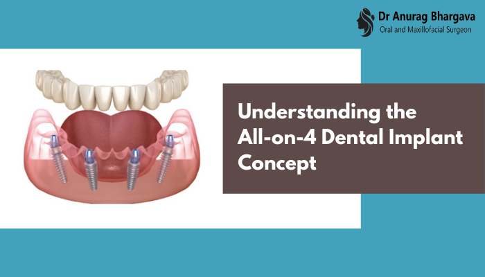 Understanding the All-on-4 Dental Implant Concept