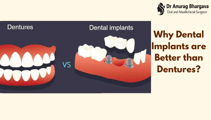 Why Dental Implants are Better than Dentures ?