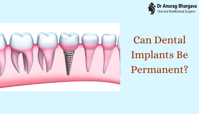 Can Dental Implants Be Permanent?