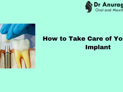 How to Take Care of Your Dental Implant ?
