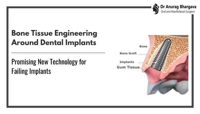 Bone Tissue Engineering Around Dental Implants | Promising New Technology for Failing Implants