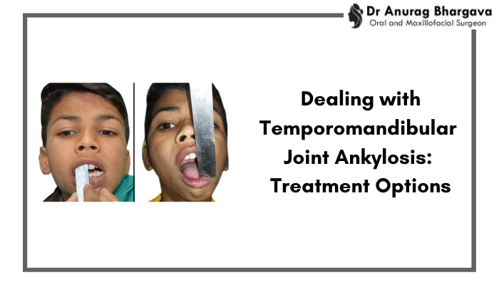 Dealing with Temporomandibular Joint Ankylosis: Treatment Options