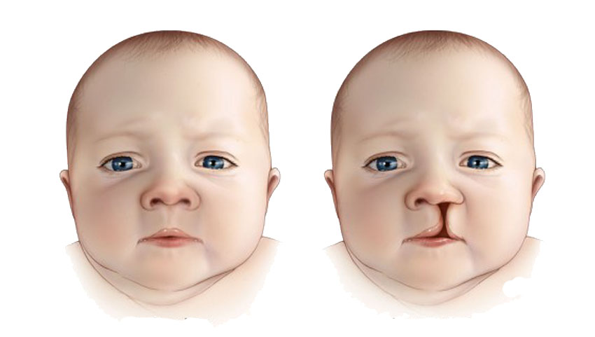 Cleft lip and Cleft palate Repair