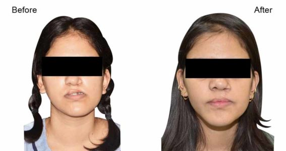 Facial Trauma| Deformity Correction by Top Maxillofacial Surgeon in Indore