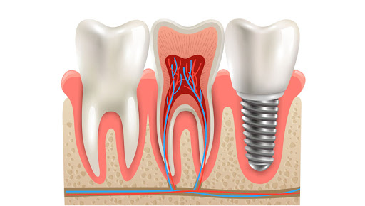 Fixed dentures/ all on 4 dental implants by Dr Bhargava