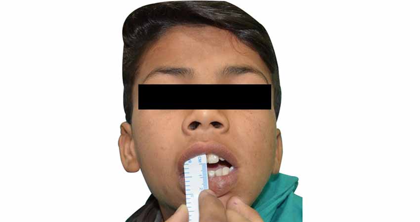 TMJ ankylosis case- difficulty opening mouth