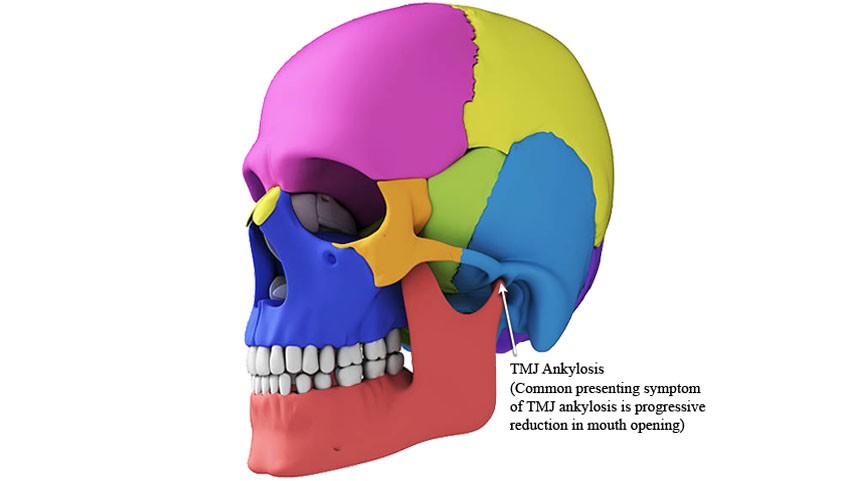 Graphical representation of common symptom of TMJ Ankylosis.