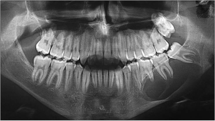 X ray showing the cyst developed in mouth