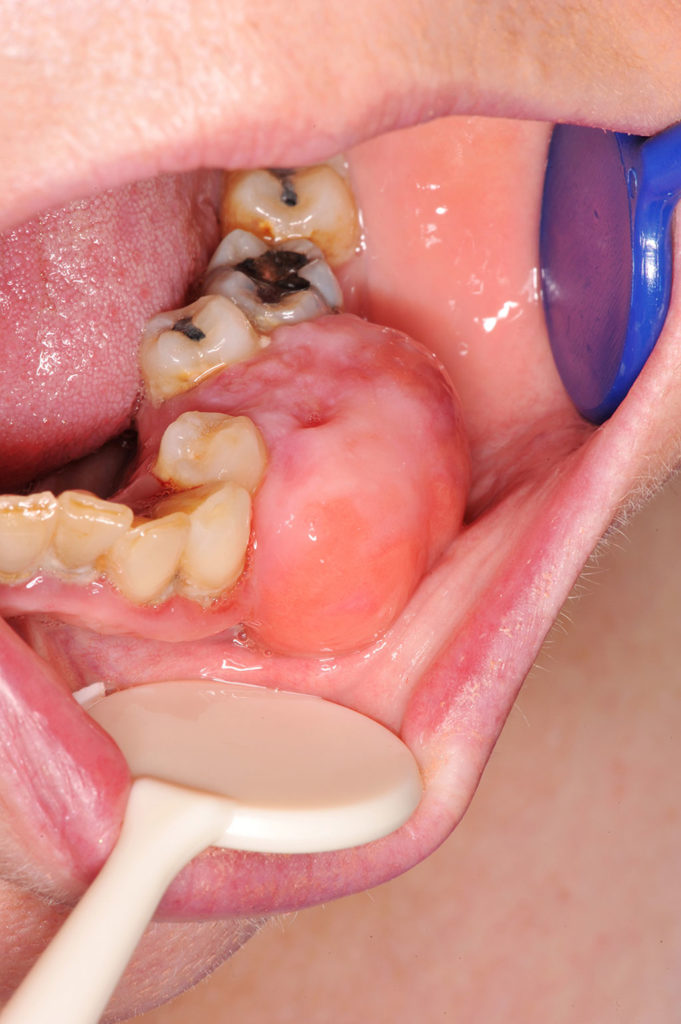 cyst and tumor in mouth