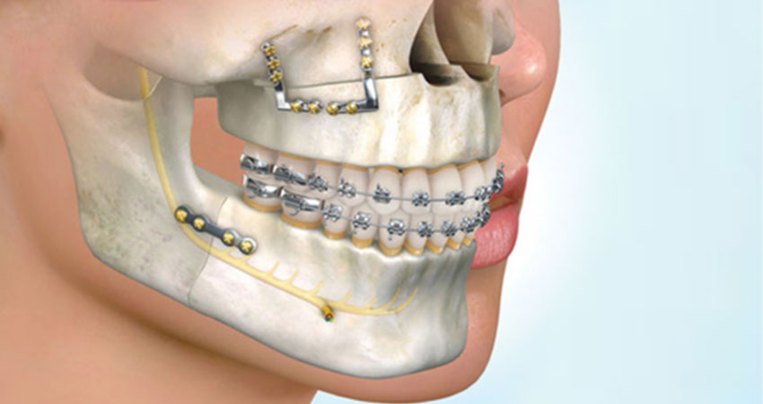 skull representation to explain the movement by jaw surgery/orthognathic surgery