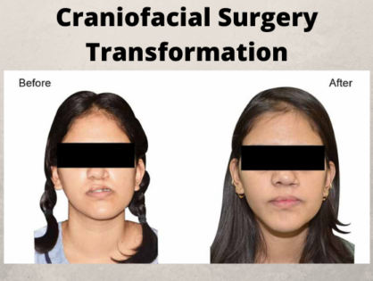 Craniofacial Surgery - A Look into Benefits & Techniques
