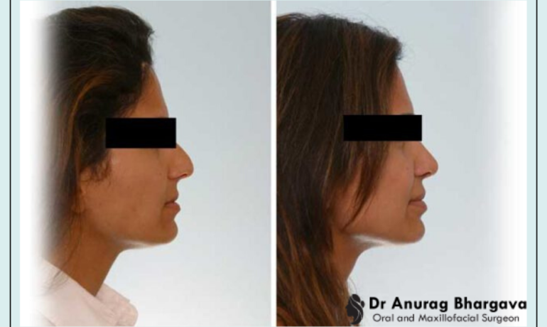 Cost of Rhinoplasty in India - It is Cheaper than you Think!