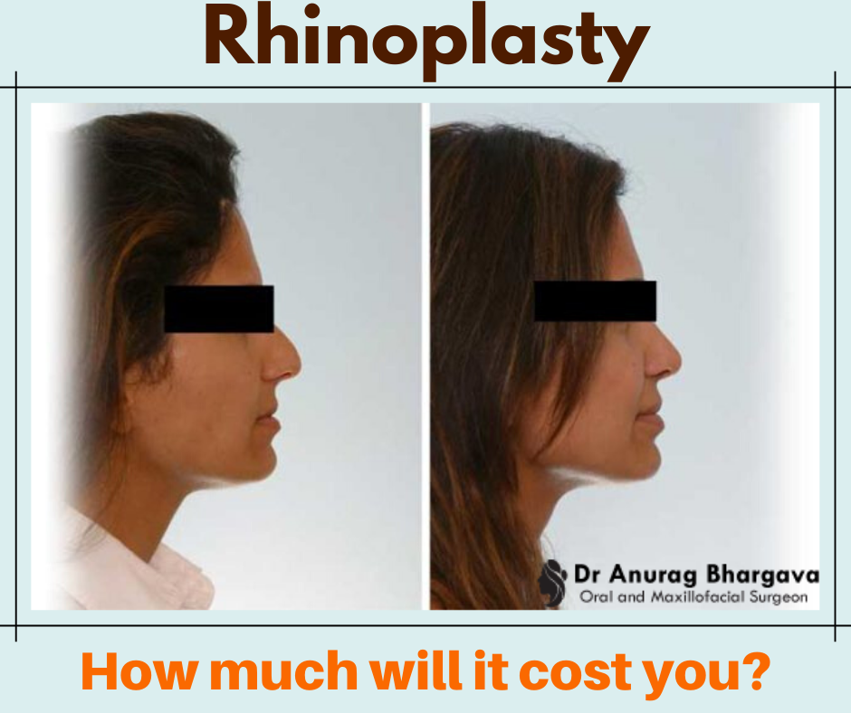Cost of Rhinoplasty in India - It is Cheaper than you Think!