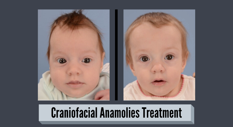 Craniofacial Anomalies - Symptoms, Diagnosis & Treatment