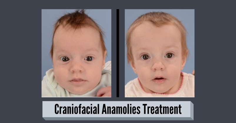 Craniofacial Anomalies - Symptoms, Diagnosis & Treatment