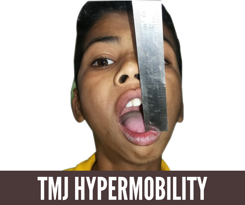 You Could Be Suffering From TMJ Hypermobility! Know Its Causes & Characteristics