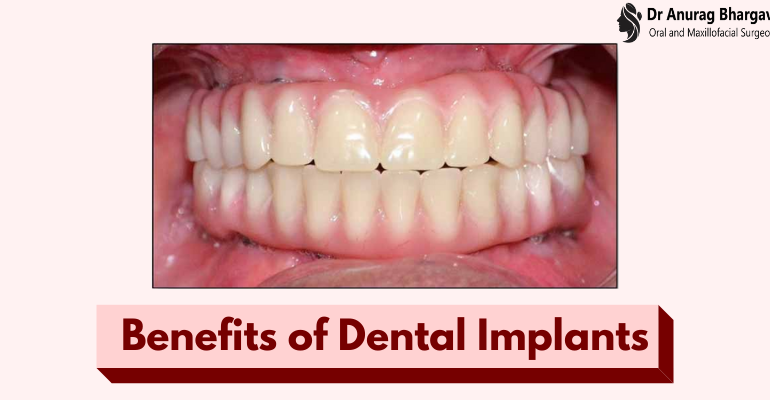 8 Benefits of Dental Implants That You Didn't Know Before