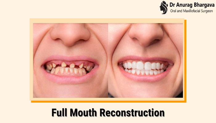 Full Mouth Reconstruction - Need, Processes Involved & Procedural Steps
