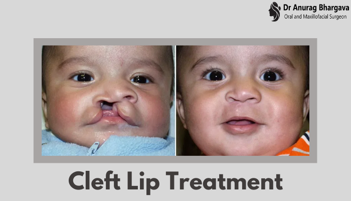 Cleft Lip Treatment - Stages, Surgery, & Recovery