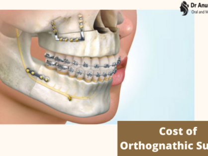 Cost of Orthognathic Surgery in India - The Exact Details by Jaw Surgeon