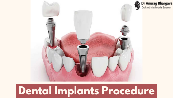 Dental Implants Procedure - Get Answer To Every Query Related To It