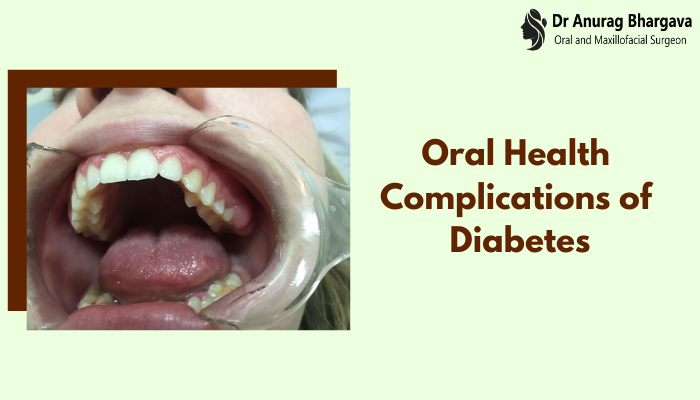 Oral Health Complications Of Diabetes That You Must Know