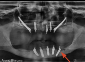 implant case-2