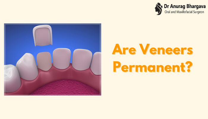 Are Veneers Permanent? Understand from the Top Dentist in Indore