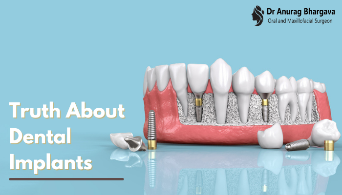 The Truth about Dental Implants: The What & the How?