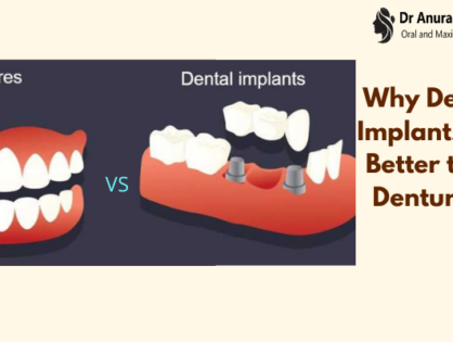 Why Dental Implants are Better than Dentures ?